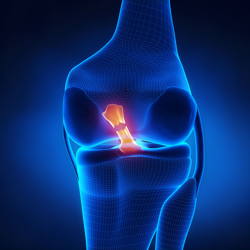 mecanismes et causes de la rupture du ligament croise