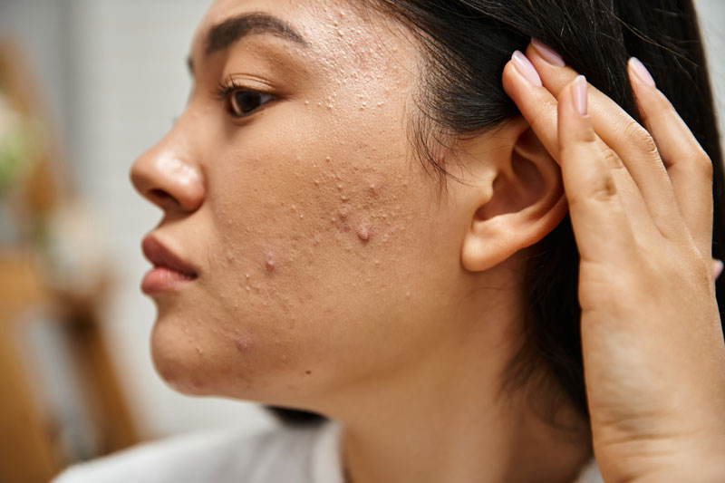 acne et les proteines en poudre un lien possible