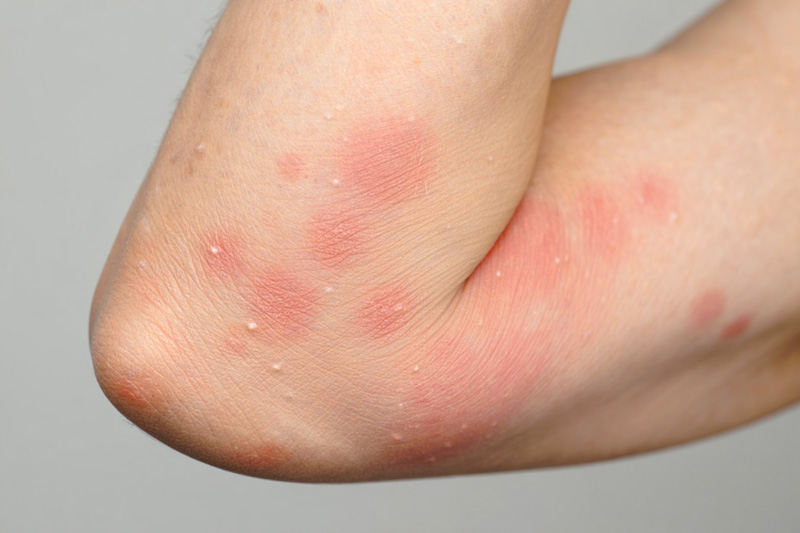 pourquoi la propolis peut declencher des effets secondaires allergiques